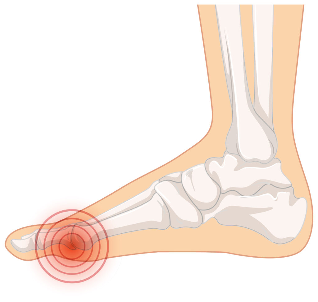 Painful Bunion New Smyrna Beach