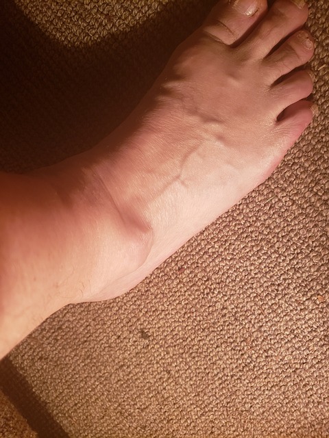 Ganglion Cyst in New Smyrna Beach